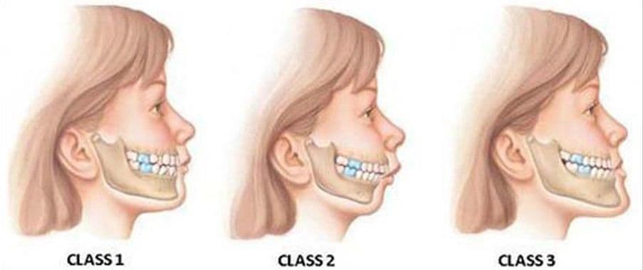 انواع کلاسفک و جراحی فک