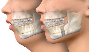 class_one_jaw