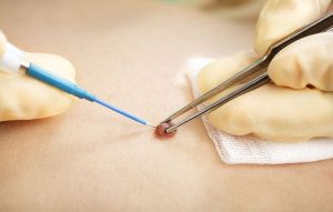 برداشتن خال صورت وبدن